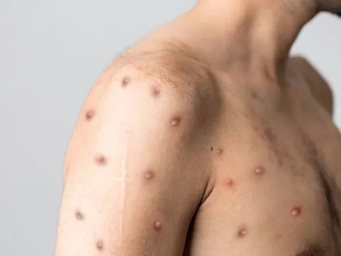 WHO cân nhắc ban bố tình trạng khẩn cấp toàn cầu về bệnh đậu mùa khỉ
