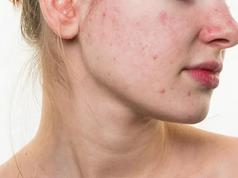 Những thói quen sai lầm khiến da bạn không thể sạch mụn