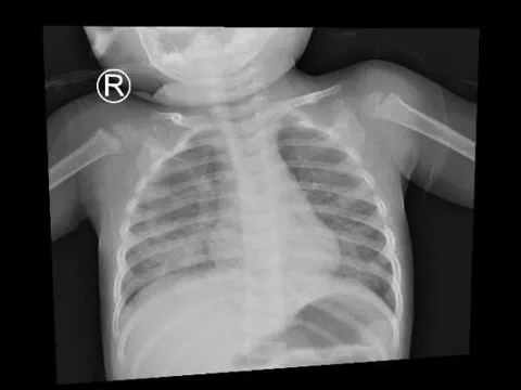 Bé trai bị viêm phổi, suy hô hấp vì uống dầu thắp đèn