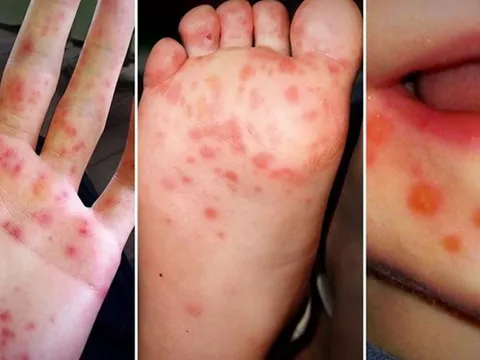 TP.HCM: Cảnh báo bệnh tay chân miệng bắt đầu gia tăng​