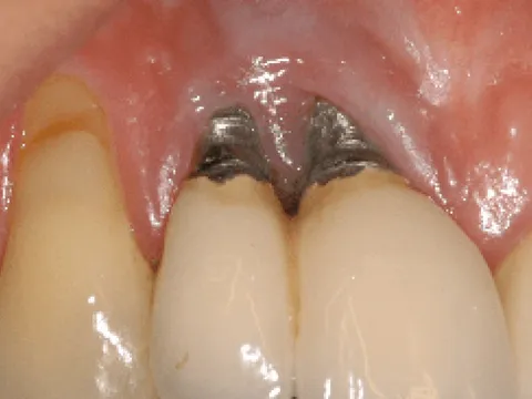 Trồng răng Implant có gây hôi miệng không? Lời khuyên từ chuyên gia