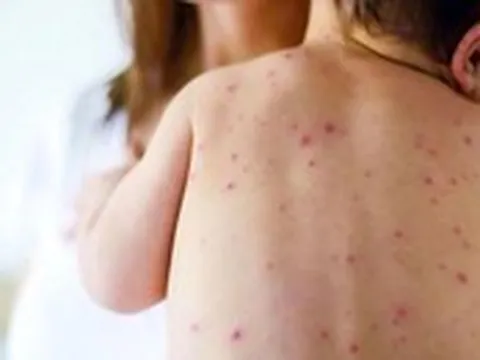 Cảnh giác với nguy cơ bệnh sởi "trở lại toàn cầu"