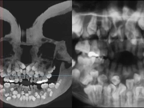 Bé gái 11 tuổi mọc 81 chiếc răng