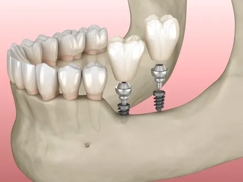 Phân biệt Minivis và Implant thông thường trong chỉnh nha