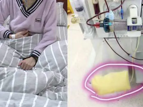 Cô gái 28 tuổi cấp cứu trong tình trạng máu vàng như 'mỡ', viêm tụy cấp nặng vì thói quen ăn uống nhiều người trẻ vẫn làm