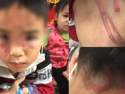 Hình ảnh cháu bé bị bố ruột bạo hành, đánh đập dã man tại Hà Nội khiến dân mạng phẫn nộ
