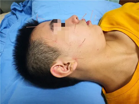 Chàng trai 20 tuổi không thể nhắm mắt, méo miệng, liệt mặt - tất cả bắt nguồn từ thói quen mà nhiều người trẻ vẫn làm hàng đêm