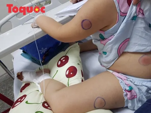 Bị gà mổ vào chân, trẻ 6 tuổi bị nhiễm vi khuẩn ăn thịt người