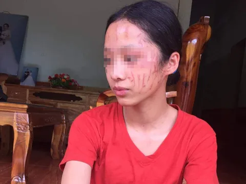 Xảy ra mâu thuẫn, nữ sinh lớp 8 ở Nghệ An bị cào xước mặt