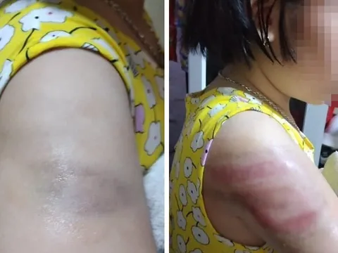 Thêm 1 vụ giáo viên bạo hành học sinh, phụ huynh bức xúc tố: Cháu bị cô đánh bầm tay vì viết bài chậm, sợ quá không dám kể với ai!