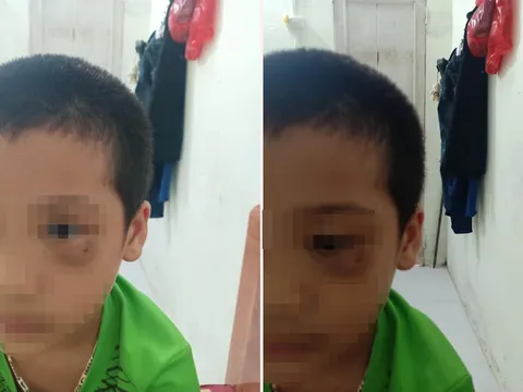 Vụ phụ huynh tát trẻ mẫu giáo: Người mẹ chính thức xin lỗi, công khai luôn ảnh đôi mắt bầm tím của con mình