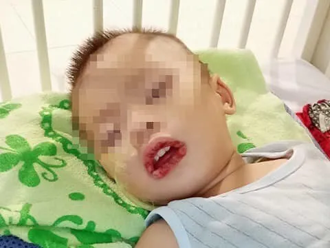 Gia đình bất cẩn, bé trai 21 tháng tuổi phải nhập viện do uống nước tẩy rửa bồn cầu