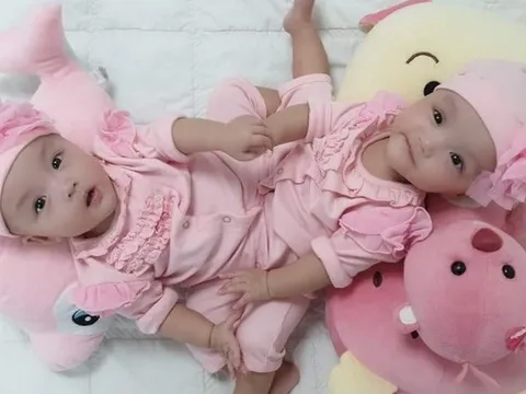 12 giờ mổ tách cho cặp song sinh dính vùng bụng chậu vô cùng hiếm gặp