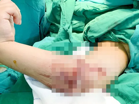 Bé trai 8 tuổi bị đứt lìa cánh tay phải, gia đình hoảng loạn bỏ vào thùng lạnh đưa con đến bệnh viện cấp cứu