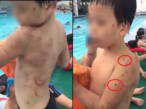 Bé trai với chi chít vết sẹo, lỗ thủng trên cơ thể nghi bị cha đẻ bạo hành