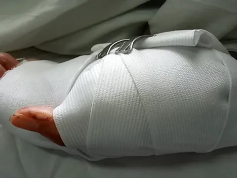 Người đàn ông 53 tuổi bị 2 thanh niên dùng mã tấu chém đứt lìa bàn tay trái